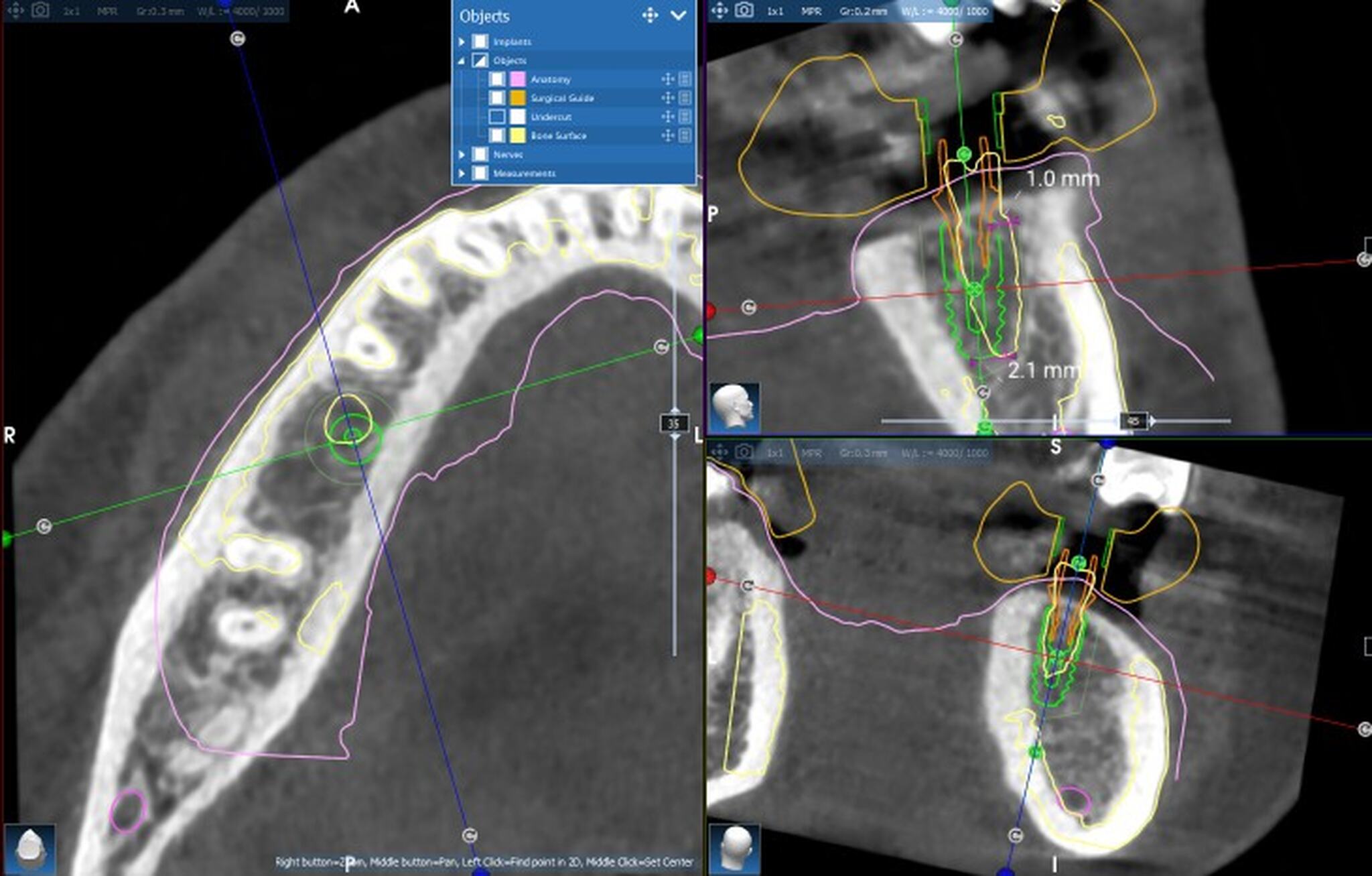 Planowanie komputerowe implantów