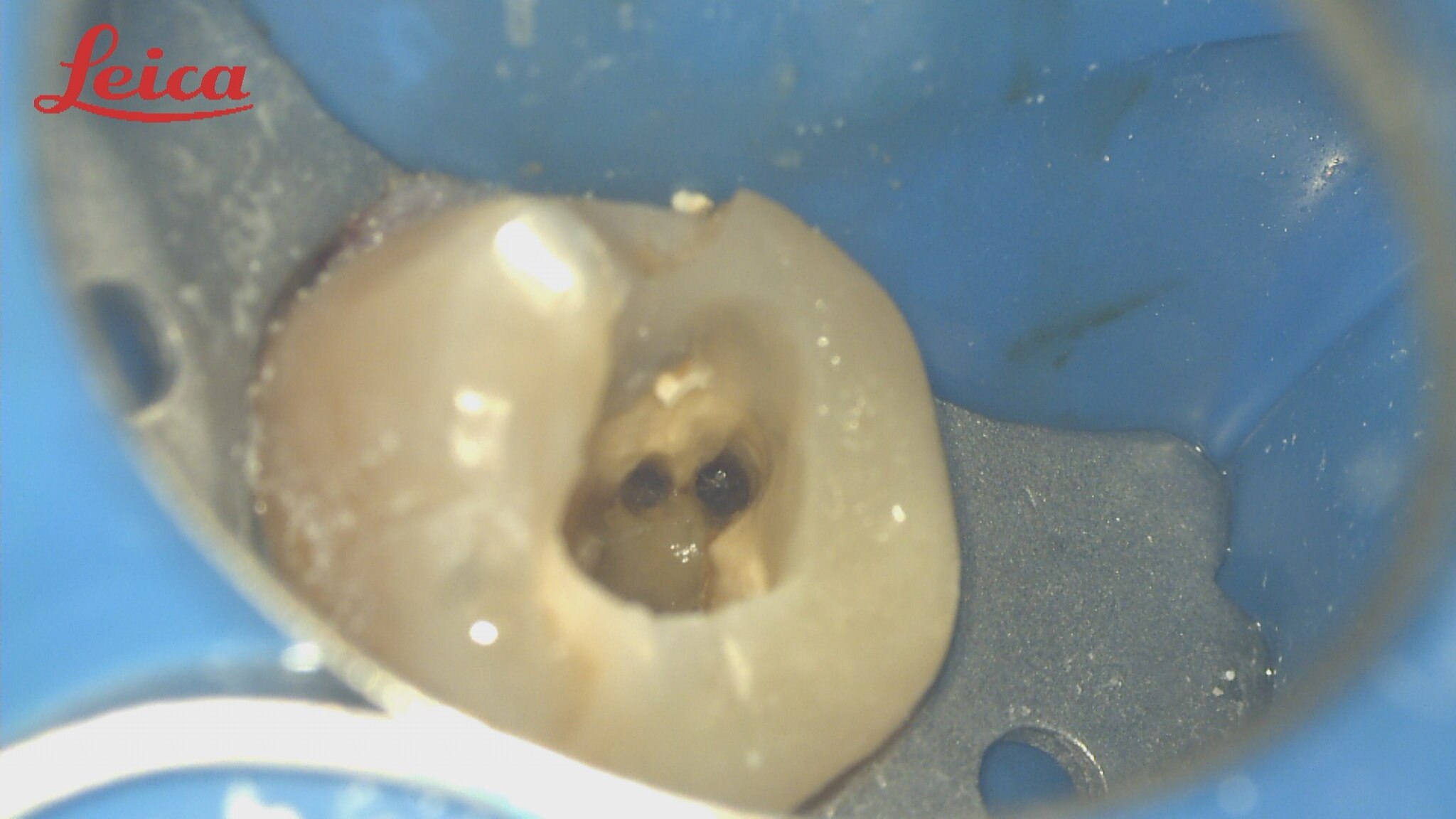 Endo 1