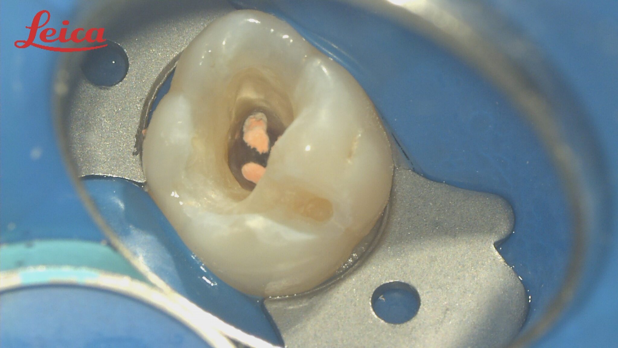 Endo 2