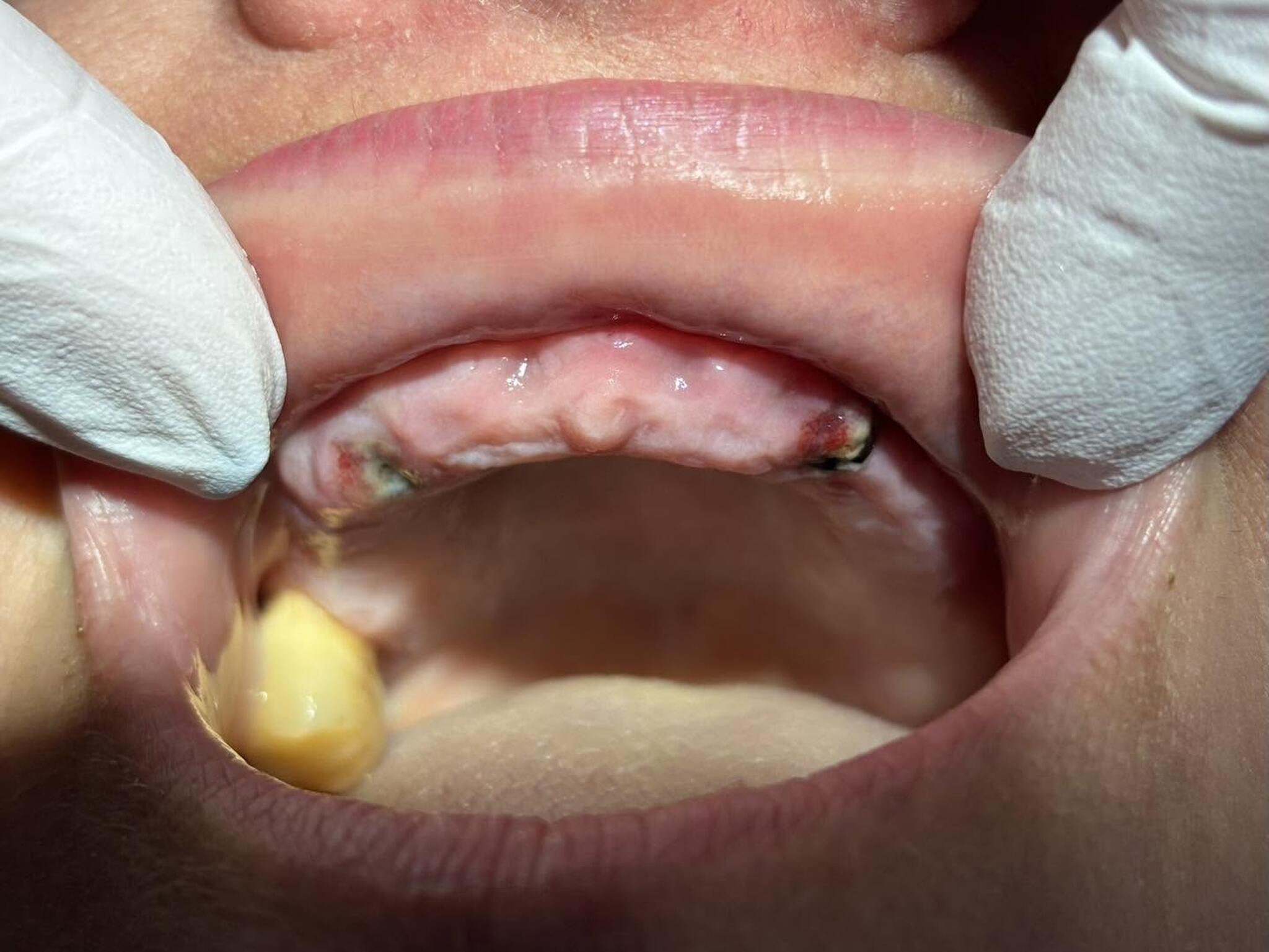 Gojenie laserowe implantów przed