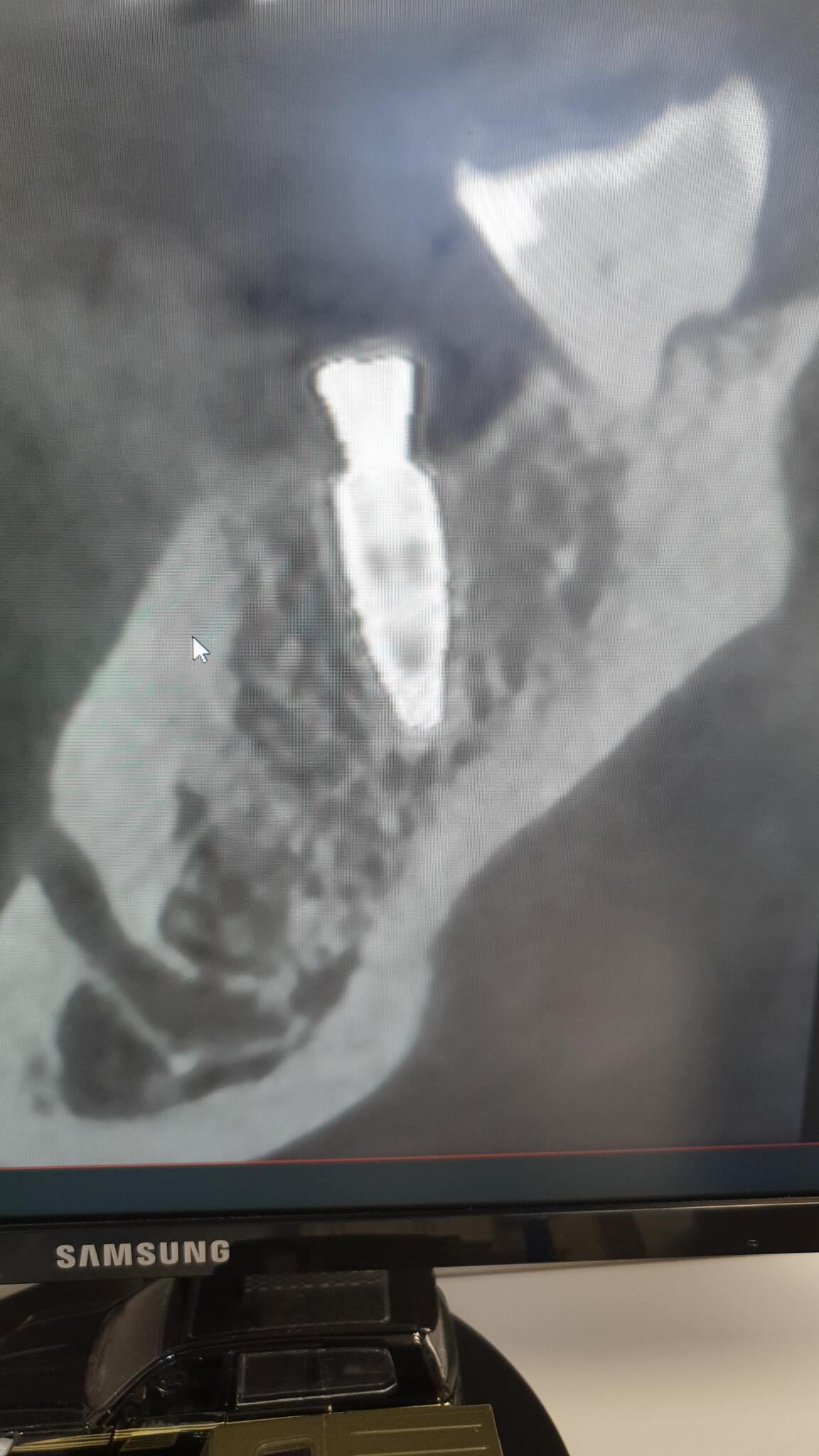 Implant ze śrubą gojącą