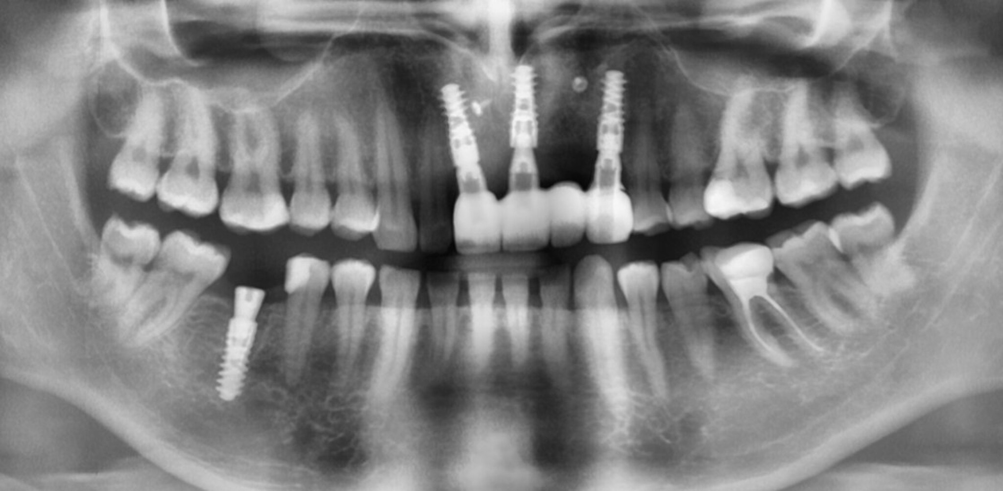 Implantacja odcinka przedniego po