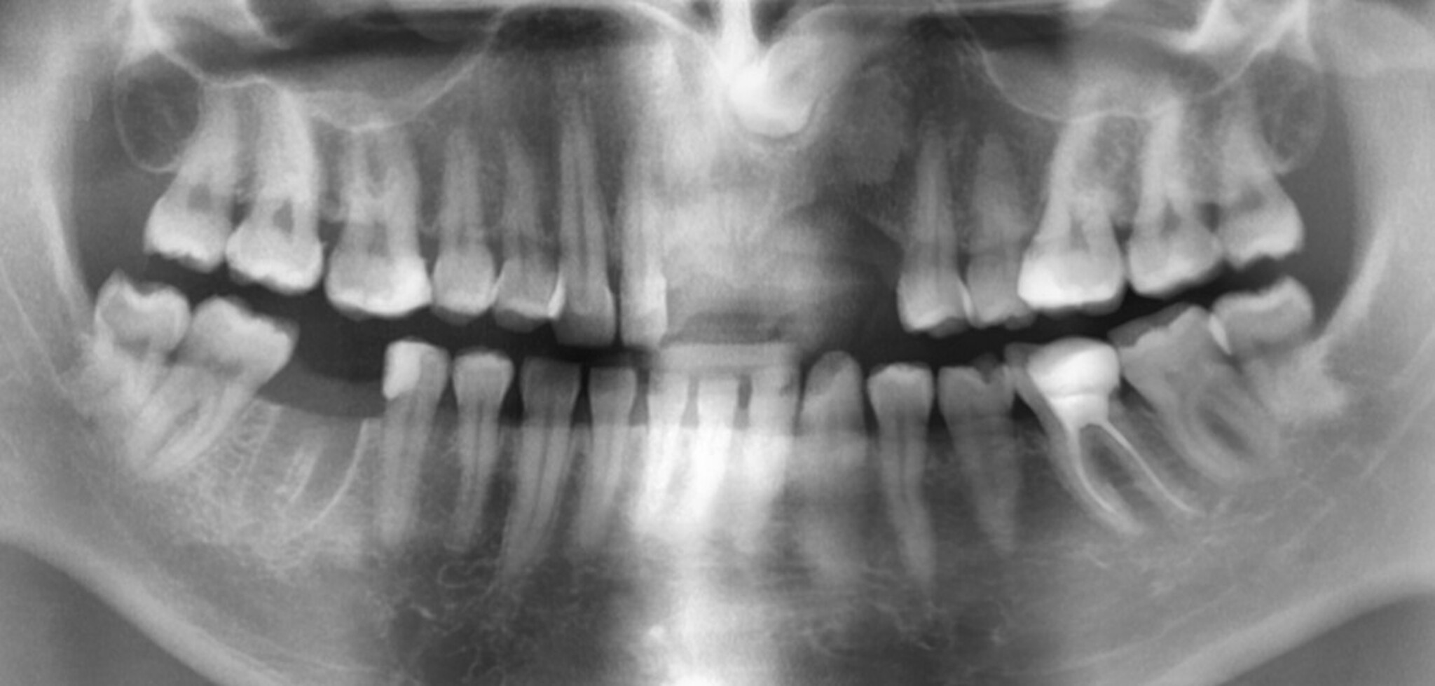 Implantacja odcinka przedniego przed