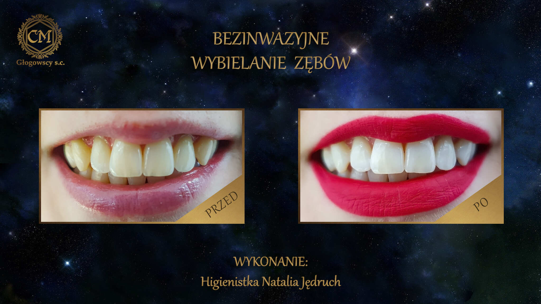 Laserowe wybielanie zębów