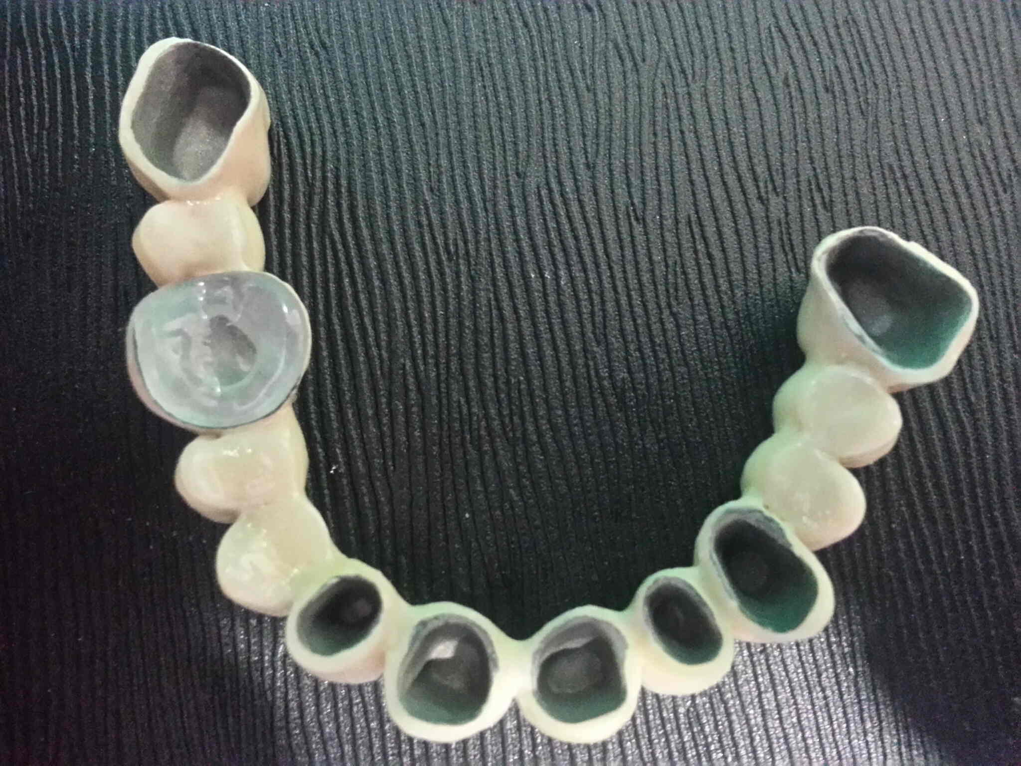 Metaloceramika 1