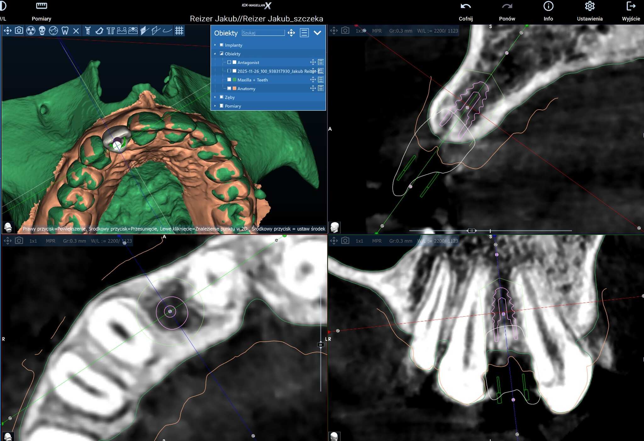 Planowanie implantu wsteczne