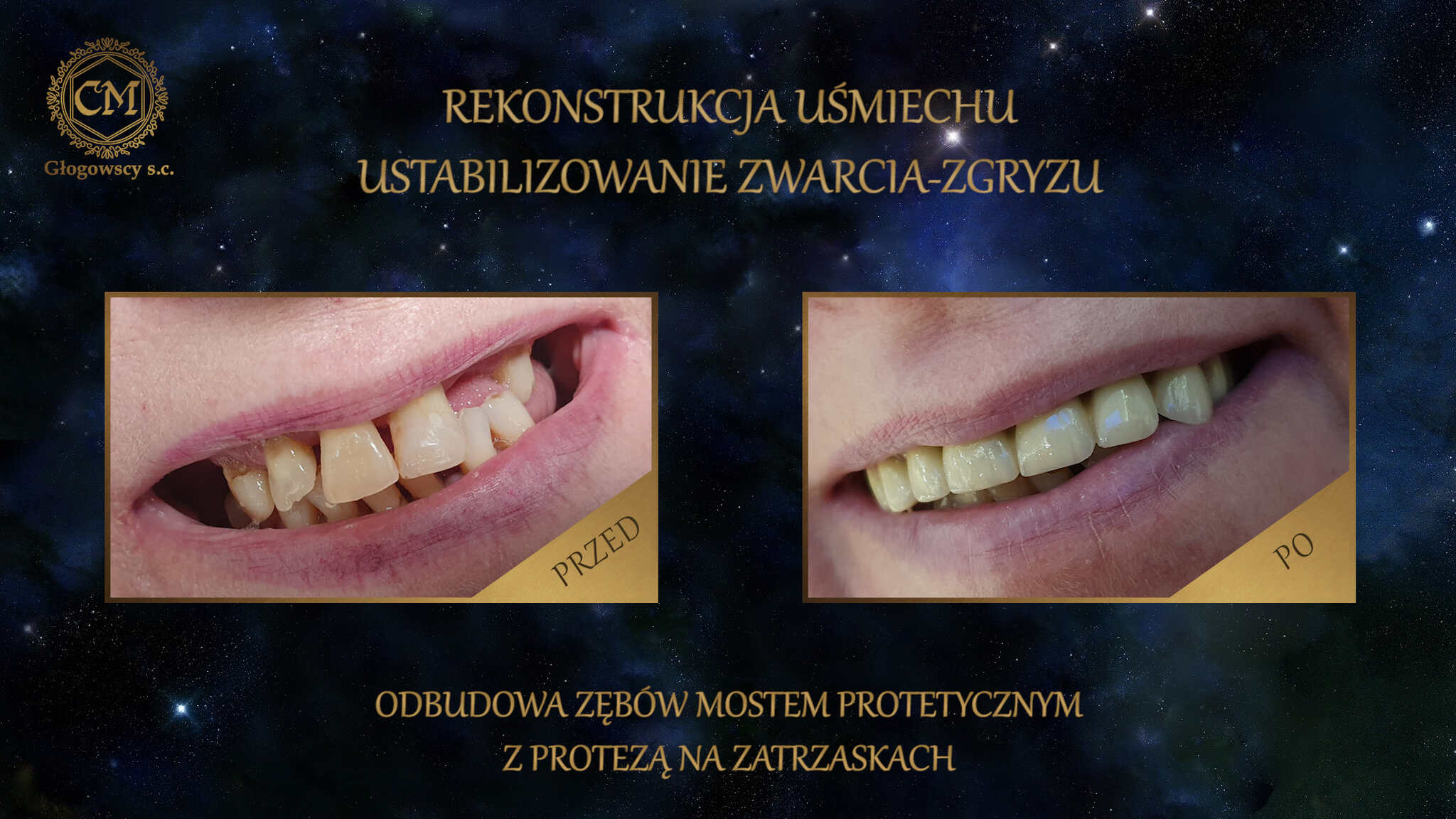 Obudowa zębów mostem z protezą