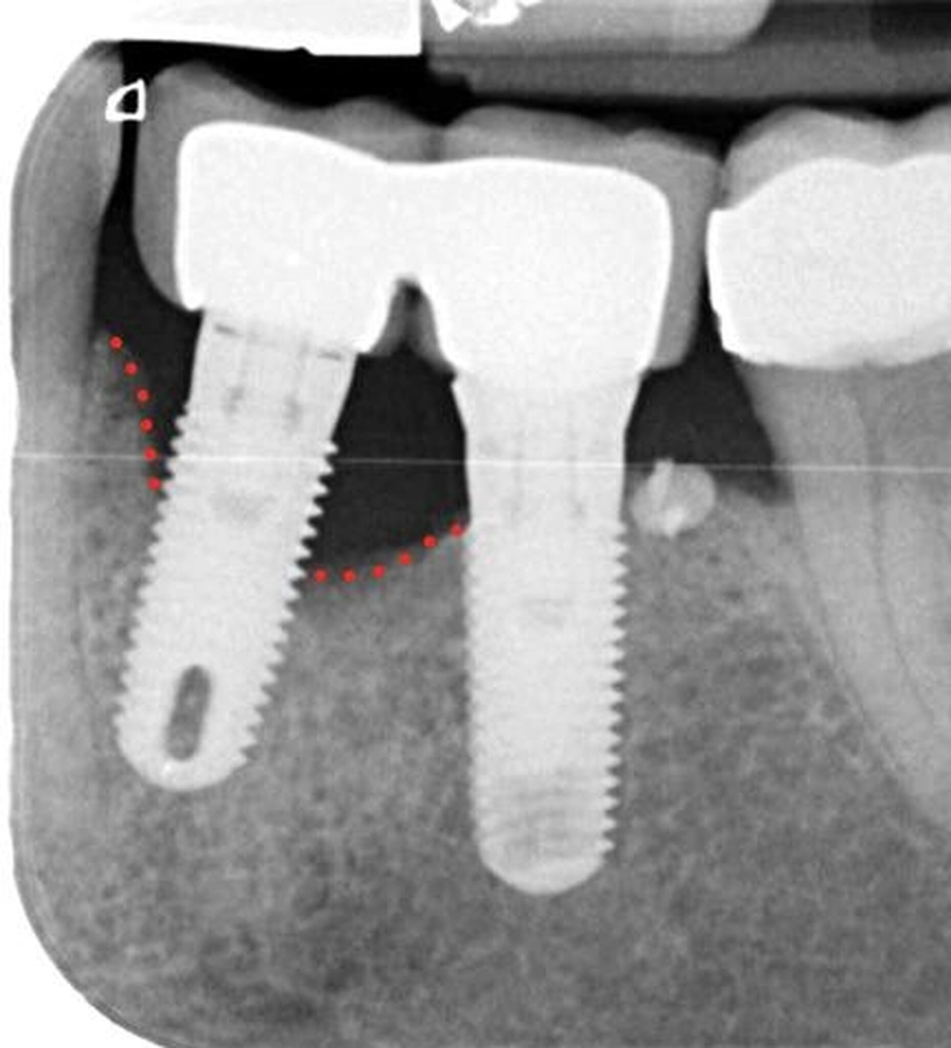 Periimplantitis zapalenie implantu