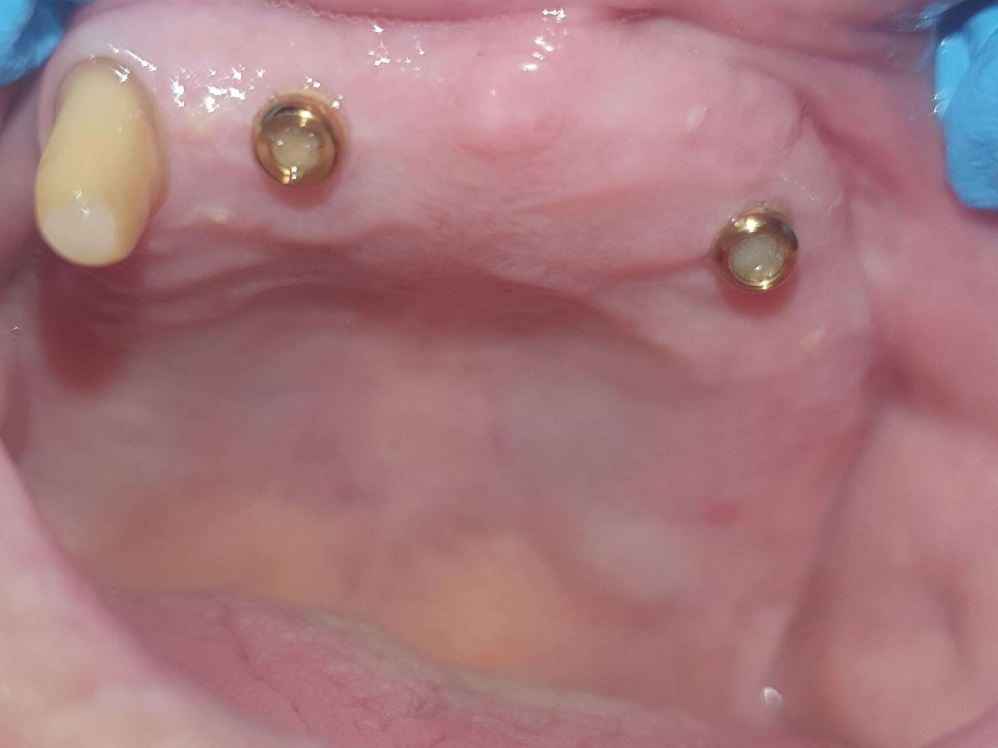 Proteza na implantach 1