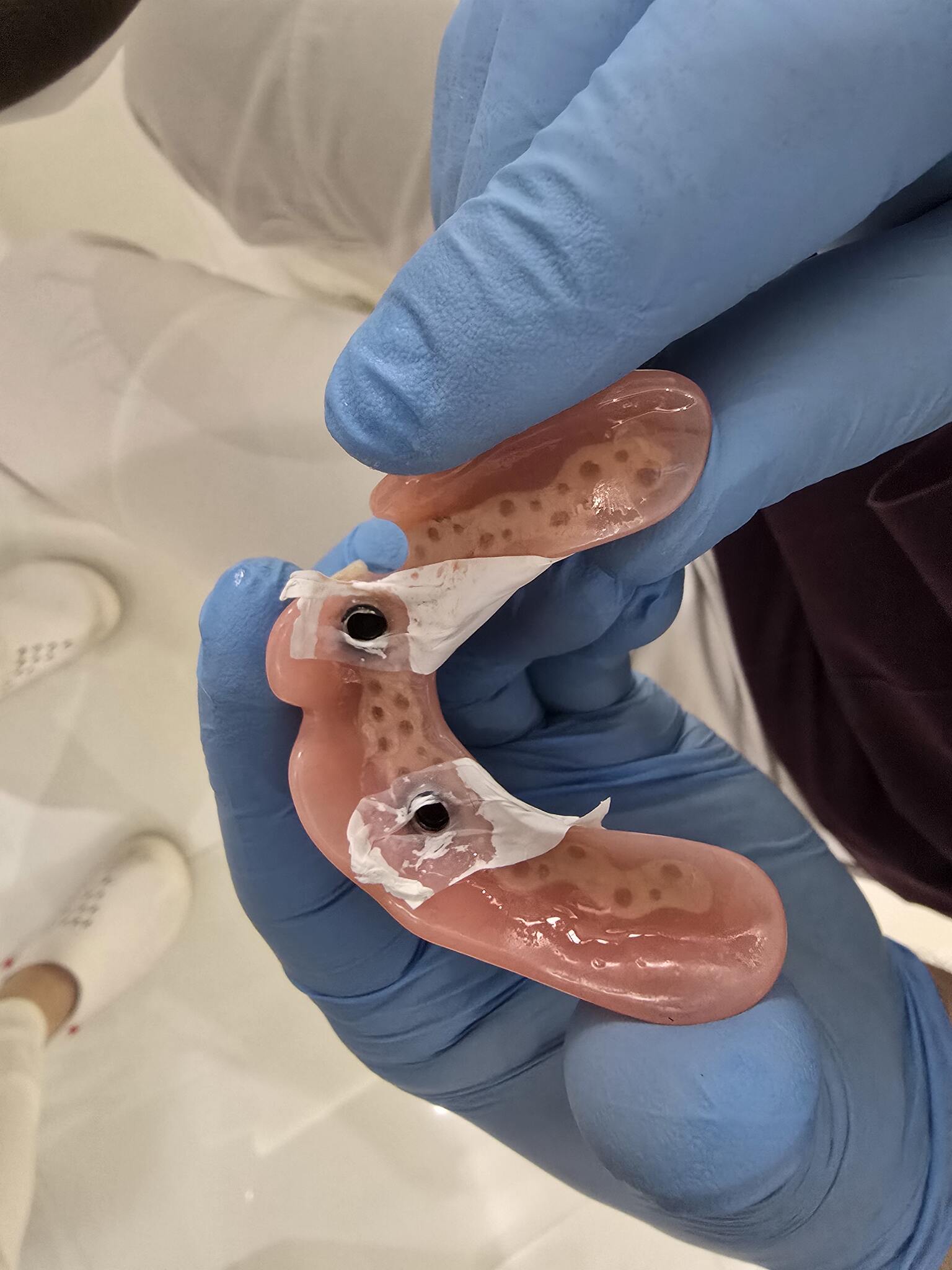 Proteza na implantach 2