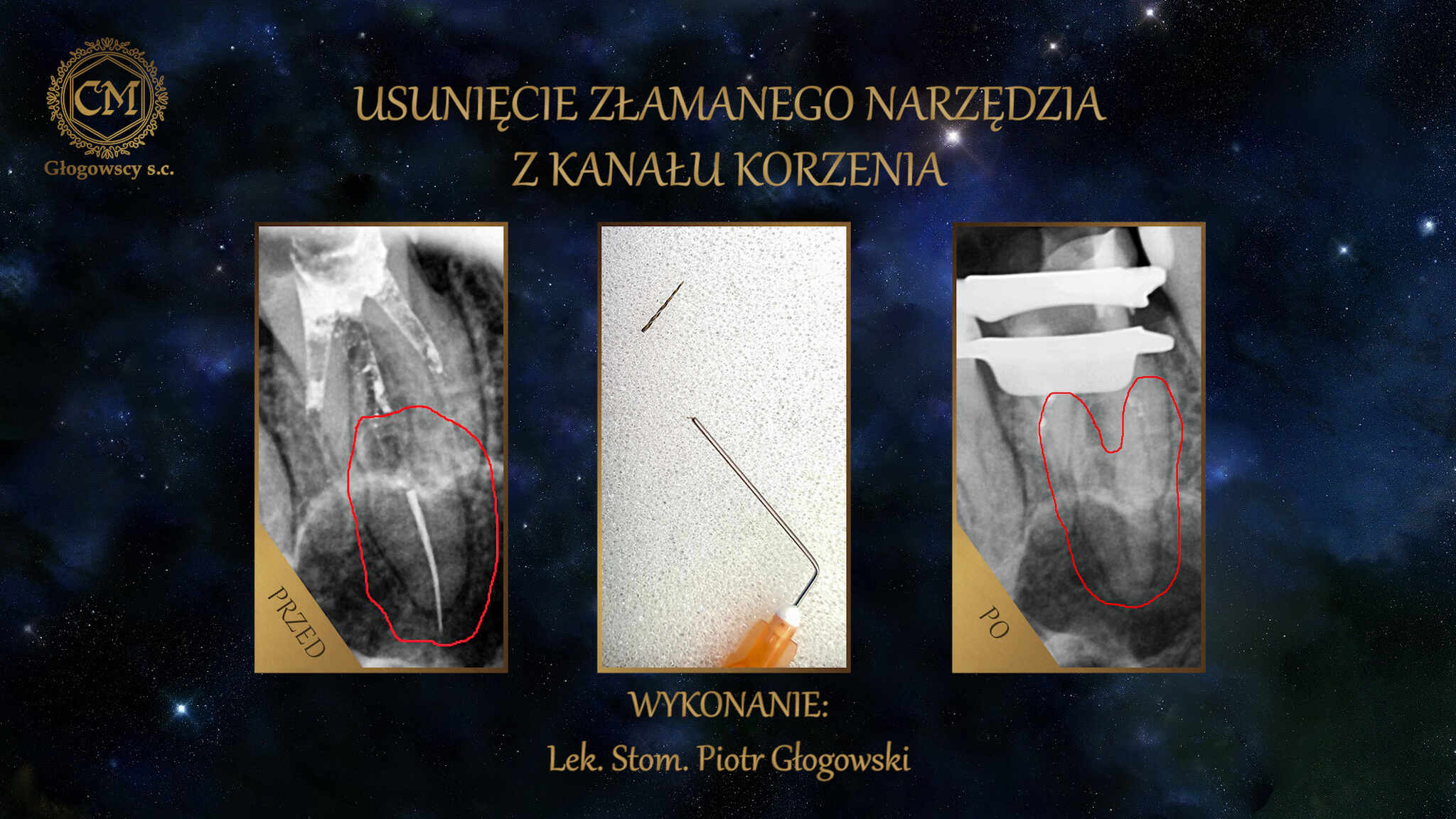 Zdjęcie: Usunięcie złamanego narzędia