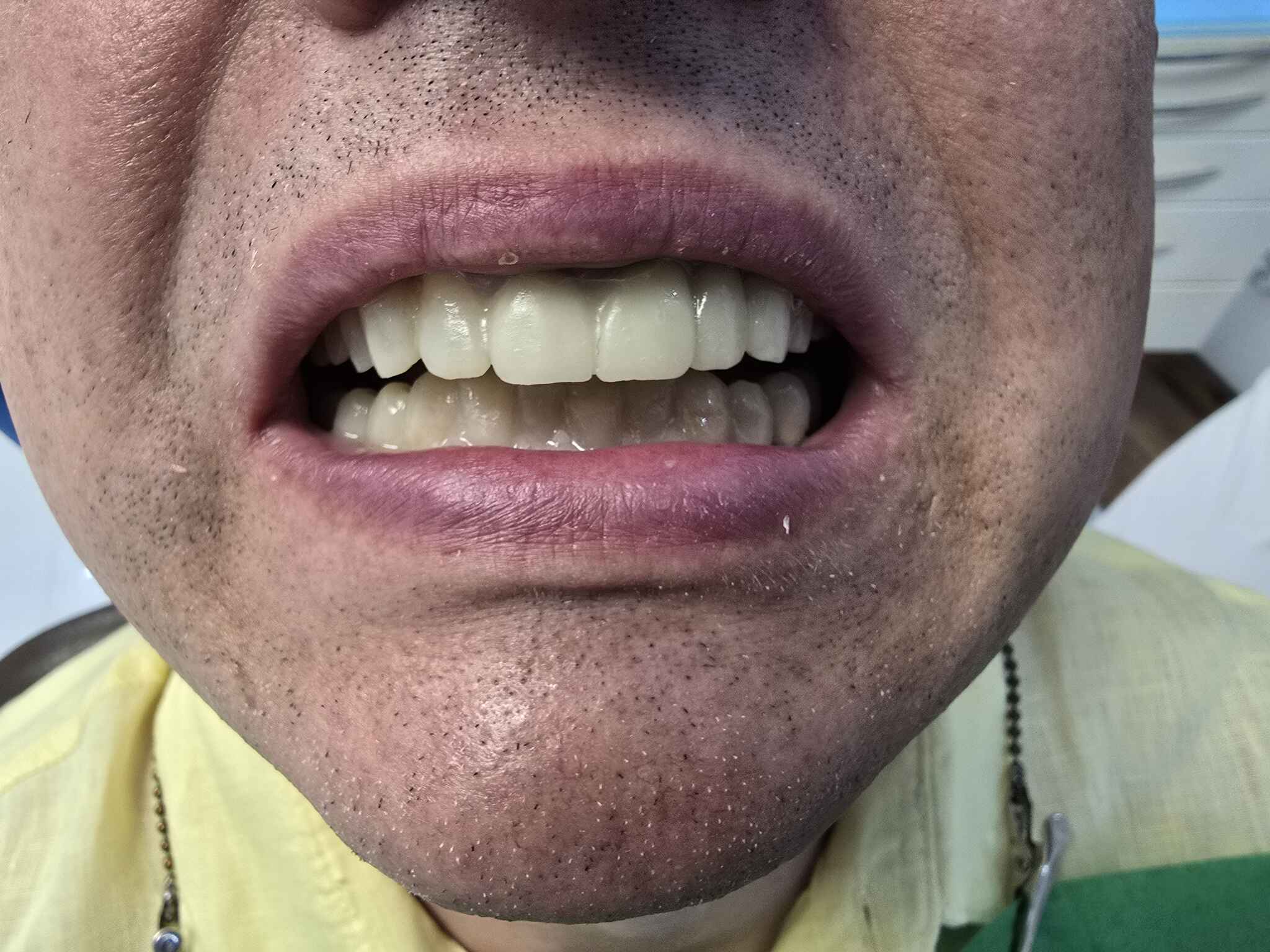 Wax up zęby próbne